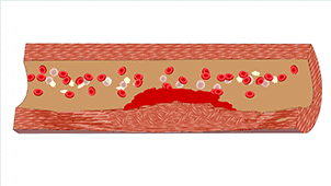 8張動圖揭秘血管堵的全過程！建議每個人都看看