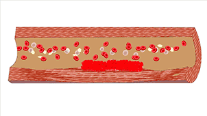 8張動圖揭秘血管堵的全過程！建議每個人都看看