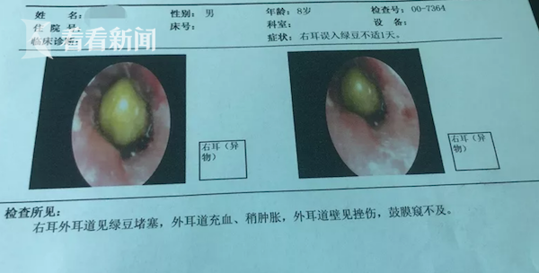 8岁男孩耳朵疼痛难忍 医生：有颗发芽的绿豆(图)
