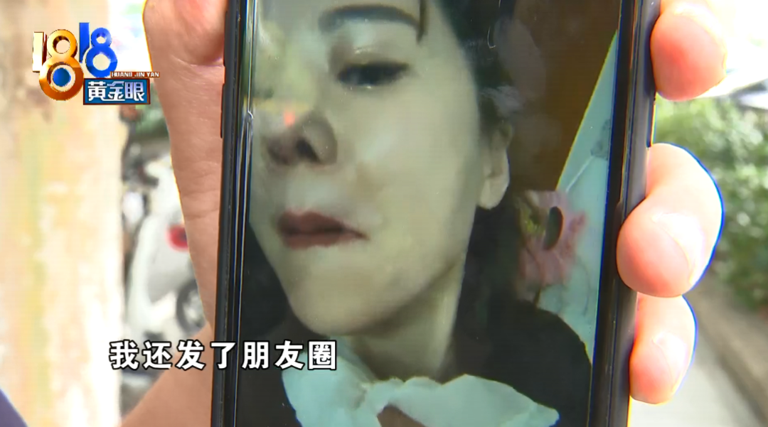 杭州女子一个喷嚏打出鼻子假体，白色的
